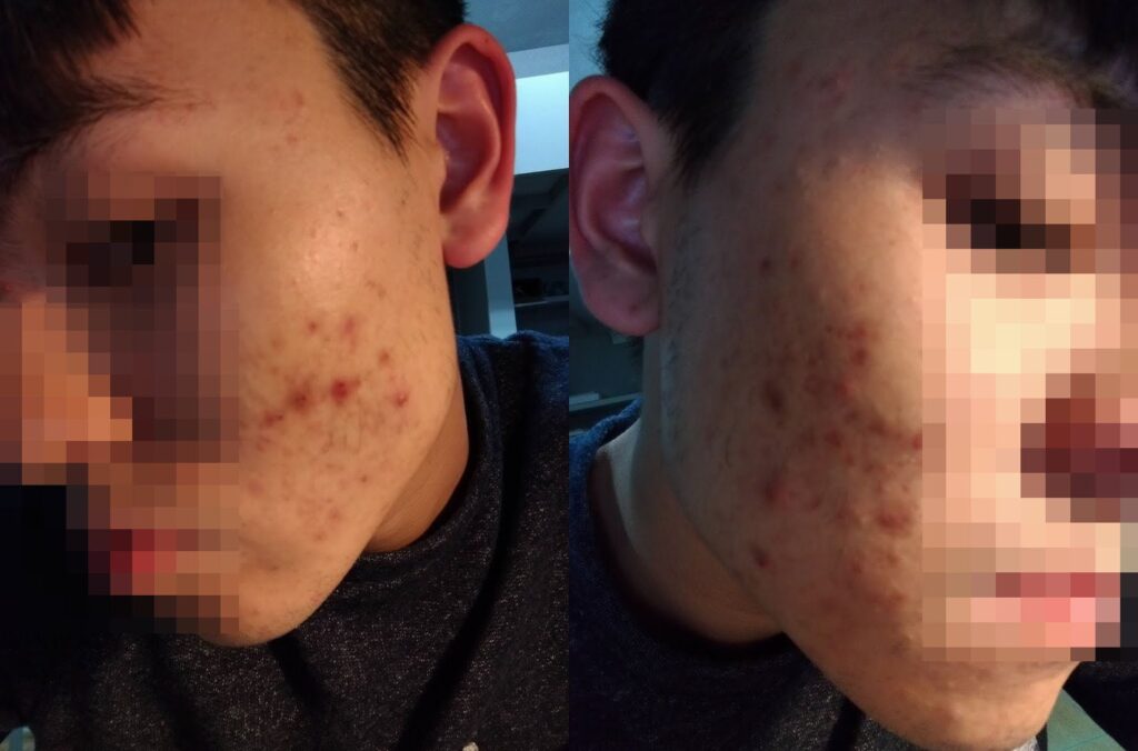 [心得] 台南林炳煌皮膚科 – 痘痘看診、初診心得